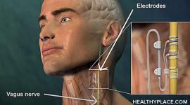 Vagus nerve stimulation is for treatment-resistant depression. Learn about VNS therapy, vagus nerve stimulation side effects and cost.